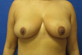 breast reduction before and after