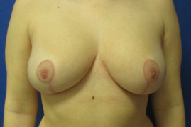 breast reduction before and after