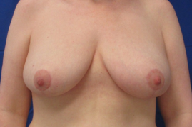breast reduction before and after