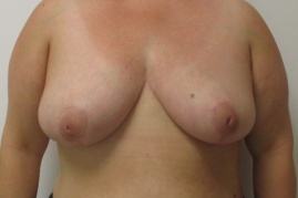 breast reduction before and after