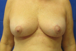 breast reduction before and after