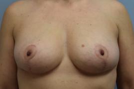 Breast Reduction