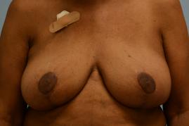 ONCOPLASTIC BREAST REDUCTION