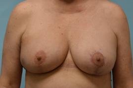 ONCOPLASTIC BREAST REDUCTION