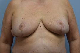 LEFT ONCOPLASTIC BREAST REDUCTION AND RIGHT BREAST REDUCTION FOR SYMMETRY