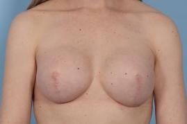 BREAST RECONSTRUCTION WITH TISSUE EXPANDER AND ADM GRAFT