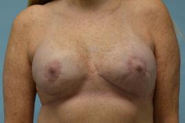 BREAST IMPLANT RECONSTRUCTION REVISION