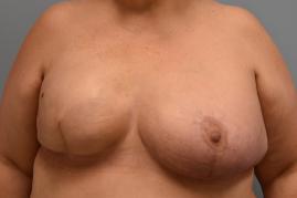 RIGHT BREAST TISSUE EXPANDER AND ADMG RAFT; RIGHT MASTOPEXY