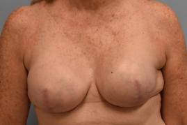 BREAST RECONSTRUCTION