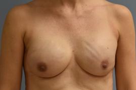 BREAST RECONSTRUCTION