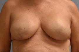BREAST RECONSTRUCTION WITH TISSUE EXPANDER AND ADM GRAFT