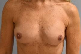 Breast Reconstruction
