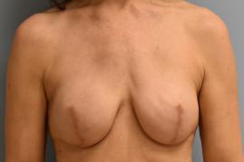 Breast Reconstruction