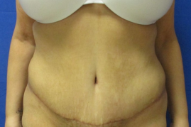 abdominoplasty before & after