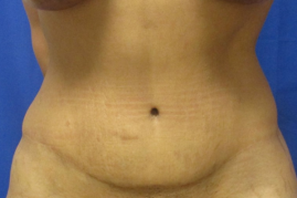abdominoplasty before & after