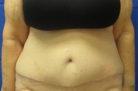 abdominoplasty before & after