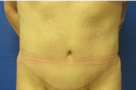 abdominoplasty before & after