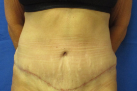 abdominoplasty before & after