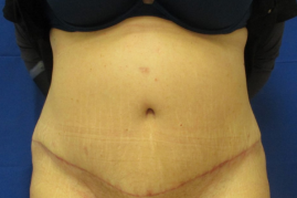 abdominoplasty before & after