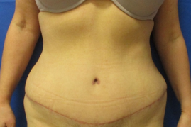abdominoplasty before & after