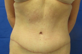 abdominoplasty before & after