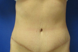 abdominoplasty before & after