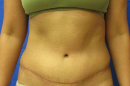 abdominoplasty before & after