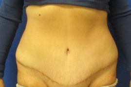 abdominoplasty before & after
