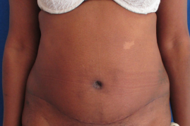 abdominoplasty before & after
