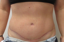abdominoplasty before & after