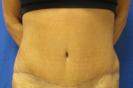 abdominoplasty before & after