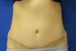 abdominoplasty before & after