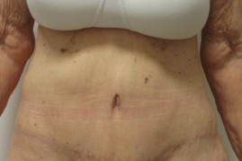 abdominoplasty before & after
