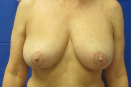 implant removal & breast lift before and after