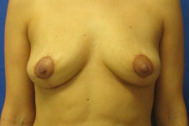 implant removal & breast lift before and after