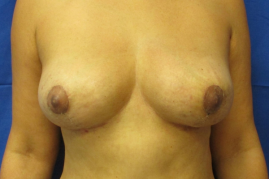 implant removal & breast lift before and after
