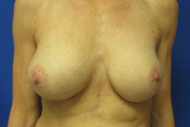 Breast augmentation before & after