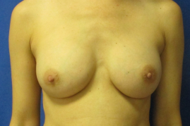 Breast augmentation before & after