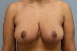 BREAST REDUCTION
