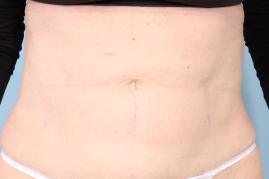 LIPOSUCTION OF ABDOMEN AND POSTRIOR FLANKS
