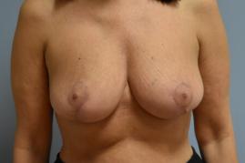 ONCOPLASTIC BREAST REDUCTION