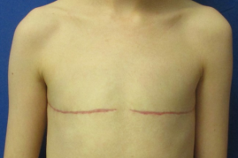 Gender affirming top surgery before & after