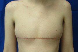 Gender affirming top surgery before & after