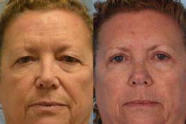 Upper Blepharoplasty before & after