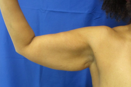 arm lift before & after