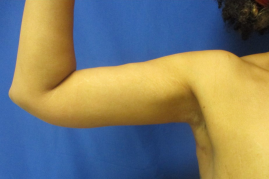 arm lift before & after