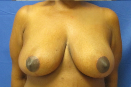 breast reduction before and after