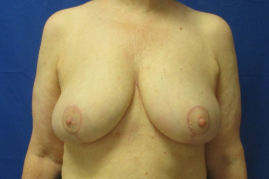 breast reduction before and after