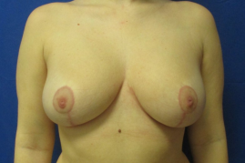 breast reduction before and after