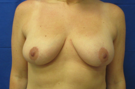 breast reduction before and after
